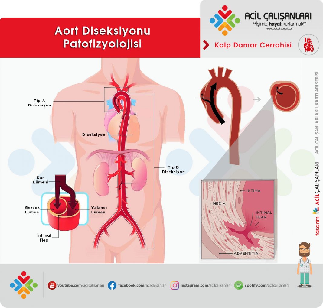 Aort Diseksiyonu Acil Al Anlar