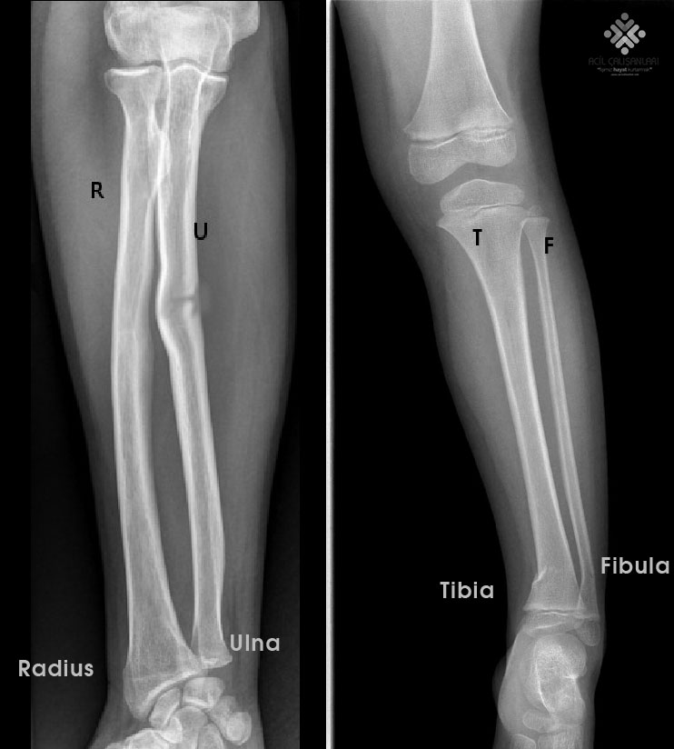 Radial Notch Of Ulna